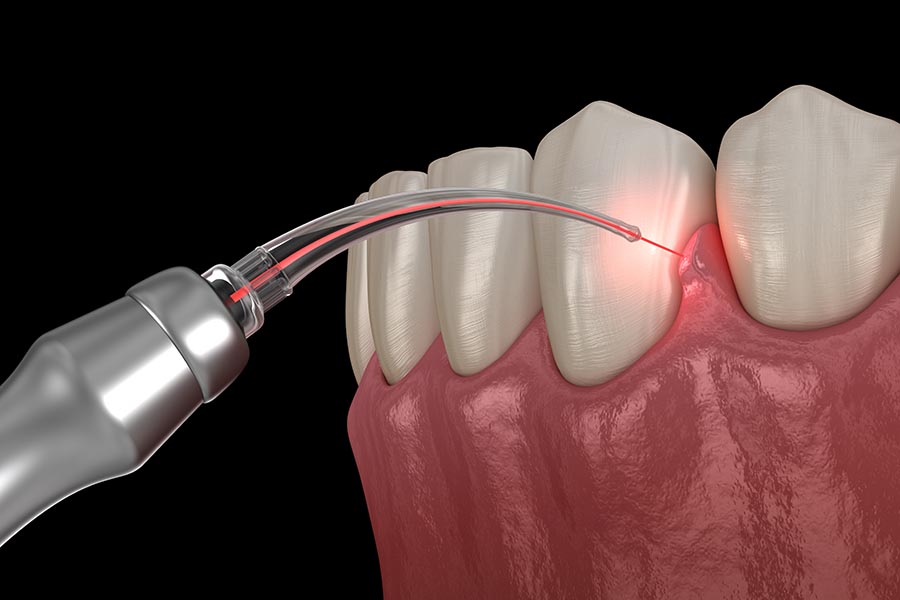 Dental Endodontic Laser