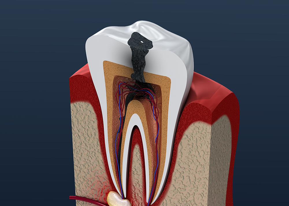 Is a Root Canal Treated Tooth Susceptible to Decay?