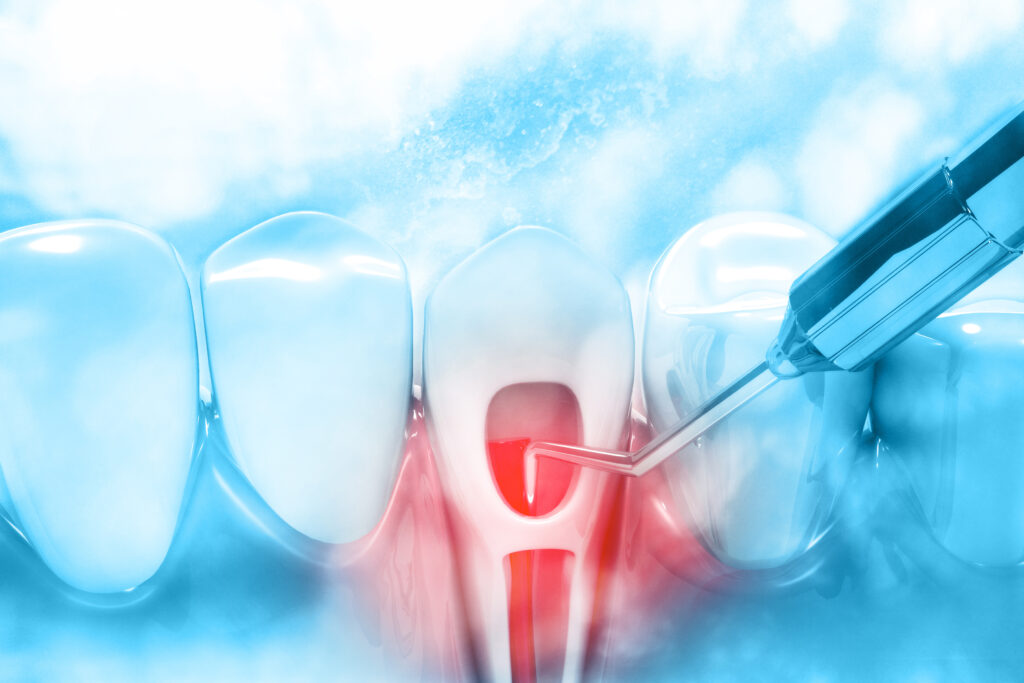 Root canal treatment process.