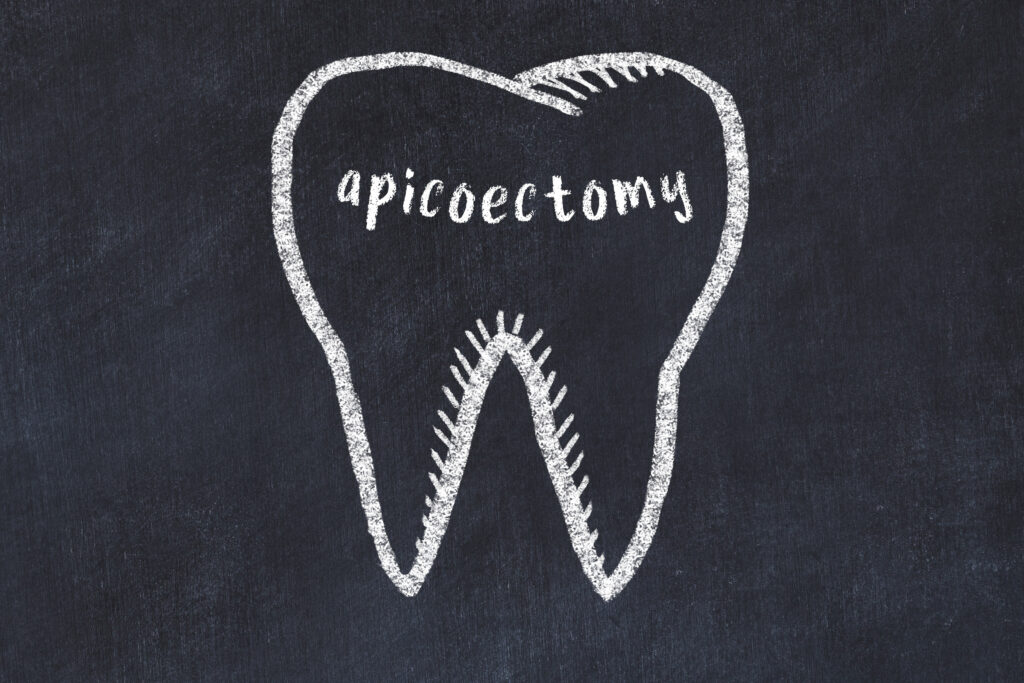 Chalk drawing of a tooth with medical term apicoectomy.