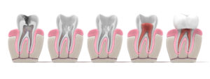 5 signs need a root canal