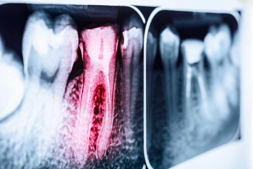 Endodontic